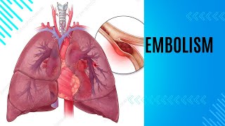 EMBOLISMTYPES AND HISTOPATHOLOGY FATEMBOLISM AIREMOLISM AMNIOTIFLUIDEMBOLISM PULMONARYEMBOLISM [upl. by Yecart]