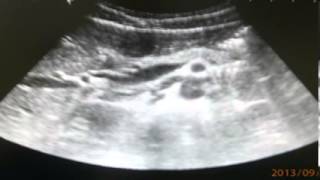 Sonographic view terminal ileitis [upl. by Lika]