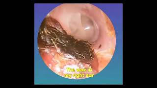 Ear hd video otoskop [upl. by Anyala]