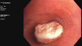 pulmonary hamartoma left lower lobe [upl. by Coral]