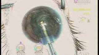 posterior polar cataract surgery by Uday Devgan MD [upl. by Aldwin]