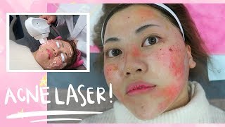 Painful ACNE LASER Experience in Korea [upl. by Cromwell]