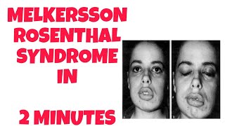 melkersson Rosenthal syndrome  2 minutes knowledge  syndrome of head and neck [upl. by Inohs]