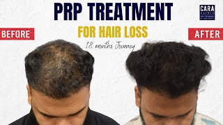 PRP hair loss treatment before and after results [upl. by Ree291]