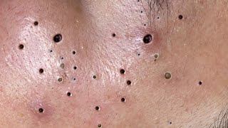 Relax Everyday with Blackheads amp Acne Treatment 19 [upl. by Garibald]