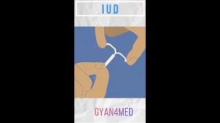 What is an IUD [upl. by Grieve]