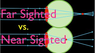 Farsighteness vs Nearsightedness An Explanation [upl. by Verdie]