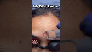 Tattoo removeshortsviralvideo [upl. by Brandenburg828]