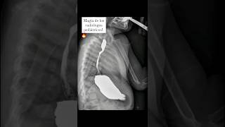 Subclavia derecha aberrante por fluoroscopia ✅ pediatrics pediatria radiology [upl. by Cibis912]