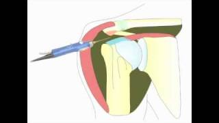 Acromioplastie arthroscopique de lépaule pour tendinite [upl. by Attekahs]