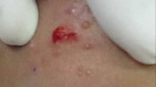 Treatment of Molluscum Contagiosumwmv [upl. by Carma]