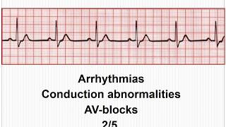 ECG Arrhythmias  AVconduction blocks 25 [upl. by Savior789]