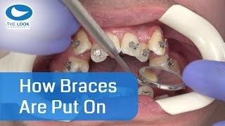 How braces are put on  AMAZING   Now with 12 month  Progress  httpsgoogljXaY15 [upl. by Noxaj]