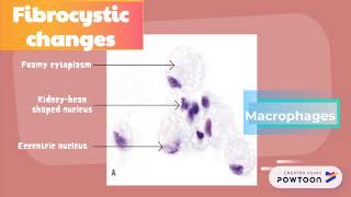 Benign Breast Lesions [upl. by Hoehne]