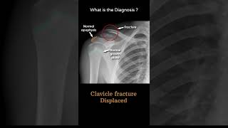 Clavicle fracture Displaced 101 Trauma Xray Upper limb Clavicle and AC jointradiologychannel007 [upl. by Garson60]