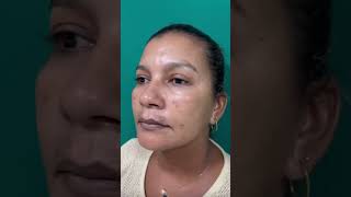 Best Dark Spots Removal for Flawless Skin darkspotsolution darkspotsremover darkspotsonface [upl. by Gnohp301]