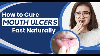 Mouth Ulcers How to Get Rid of Mouth Ulcers Overnight  The Health Site [upl. by Centonze]