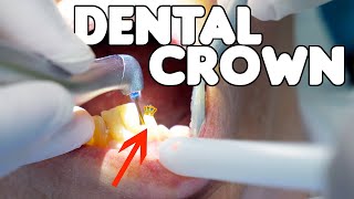 Dental Crown Procedure EXPLAINED [upl. by Etiuqram678]