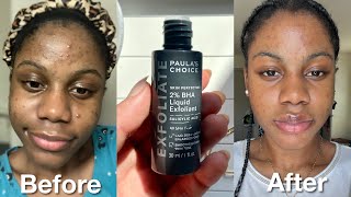 I Tried Paulas Choice Skin Perfecting 2 BHA Liquid Exfoliant For 2 Weeks  Before amp after results [upl. by Onitnerolf22]