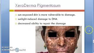 Pathology 761 d Skin XeroDerma Pigmentosum Stratum spinosum pre malignant lesion melanin [upl. by Anitnerolf]