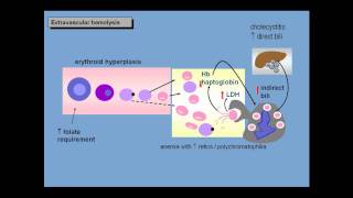 Anemia of increased red cell destruction loss [upl. by Dlared]