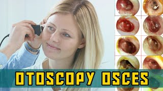 OTOSCOPY OSCEs  PLAB Image Reference [upl. by Brie]