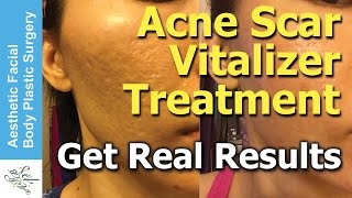 Treat All Types of Acne Scars in One Treatment in 2 Hours with the New Acne Scar Vitalizer Treatment [upl. by Bobbette980]