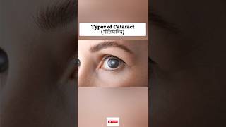 मोतियाबिंद  Types of cataract [upl. by Hartill]