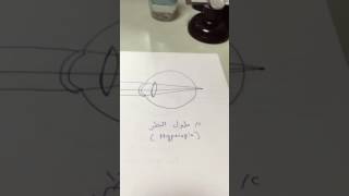 العيوب الانكسارية Refractive Errors د حافظ الفالح [upl. by Lower]