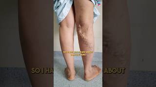 Can You Really Get Rid of Varicose Veins in Just 24 Hours [upl. by Zurkow715]