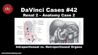 Intraperitoneal vs Retroperitoneal Hemorrhage DaVinciCases Renal 2  Anatomy Case 2 [upl. by Adyela]