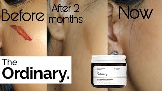 5 Month Update on The Ordinary 100 Lascorbic Acid Powder  Answering your questions [upl. by Tezile]