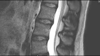 How to Read an MRI Scan of the Lumbar Spine  First Look MRI [upl. by Akkahs]