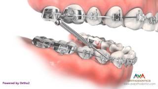 Orthodontic Treatment for Overjet Overbite  Forsus Appliance [upl. by Ianaj]