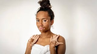 The herbal medicine that works for Vitiligo DoctorIyhere [upl. by Publias]