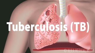 Tuberculosis TB Progression of the Disease Latent and Active Infections [upl. by Gladdie851]