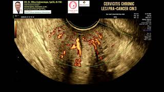 Cervicitis chronic  Lesi Pracancer  CIN 3 [upl. by Ahsieyk]