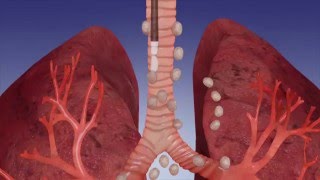 EBUS Procedure OverviewOlympus Bronchoscopy [upl. by Hakvir295]