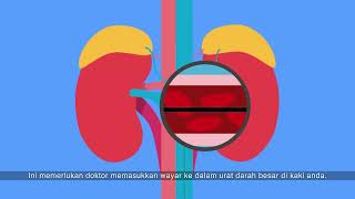 Primary Aldosteronism identifying the abnormal adrenal gland Malay [upl. by Melone]