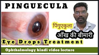 what is Pinguecula treatment  Pinguecula treatment Pinguecula treatment eye drops [upl. by Swinton]