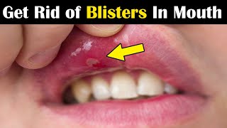 How to Get Rid of Blisters in Mouth fast  8 Home Remedies for Blisters in Mouth and Tongue [upl. by Aivatnohs214]