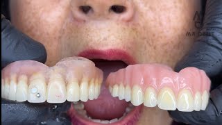 PRÓTESIS DENTAL FLEXIBLE O ACRILICA  🤔🤔 viral odontologia fypシ [upl. by Eiba]