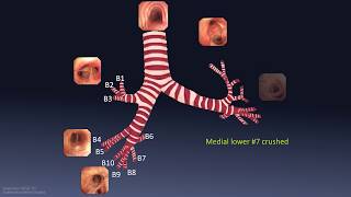 Mastering Bronchoscopy for Thoracic Surgery Chapter 1 [upl. by Htebesile]