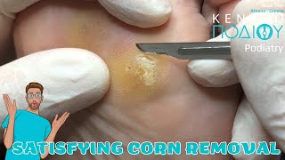 Corn Removal feet κεντροποδιου foot podologos podiatrist corn footcare podiatry callus [upl. by Niahs]