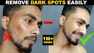 DARK SPOT कैसे हटाये  How To Remove DARK SPOTS amp SCARS NATURALLY ACNE SCARS ACNE MARK  2021 [upl. by Enale]