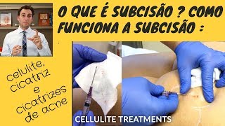 O que é subcisão  Como funciona a Subcisão para celulite cicatriz e cicatrizes de acne [upl. by Claretta]