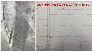 LBBAP WITH BIOTRONIK SYSTEM [upl. by Ferriter]