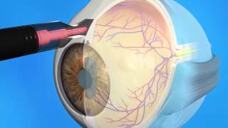 Glaucoma Cyclophotocoagulation CPC [upl. by Irret]