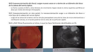 Retinopatía diabética y Edema macularZP [upl. by Alicul86]