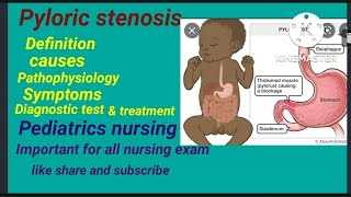 pyloric stenosis  causes  symptoms diagnostic test  treatment  pediatrics nursing Hindi lecture [upl. by Korb]